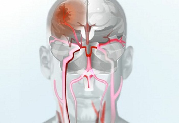 A túlzott alkoholfogyasztás stroke-ot okozhat