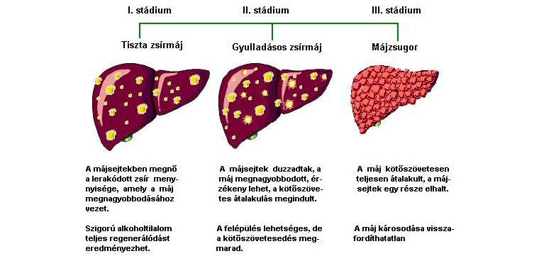 Az alkoholos májbetegség három stádiuma